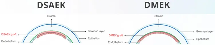 Imagem ilustrativa dos transplantes lamelares posteriores: à esquerda o DSAEK/DSEK com córnea doadora contendo parte de estroma, Descemet e endotélio e à direita o DMEK com córnea doadora contendo apenas Descemet e endotélio