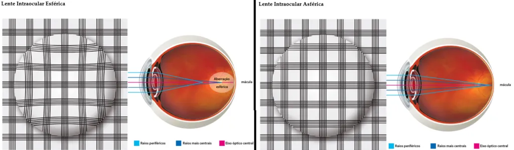 Imagem mostrando visão com lente esférica e com lente asférica