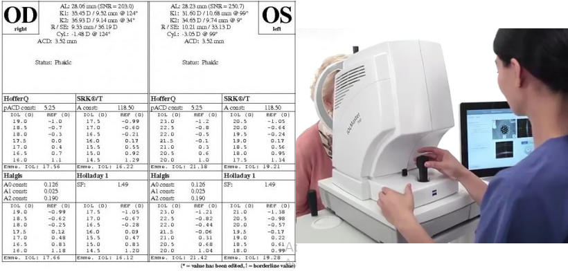 Imagem de exame de biometria óptica com o cálculo do grau das lentes