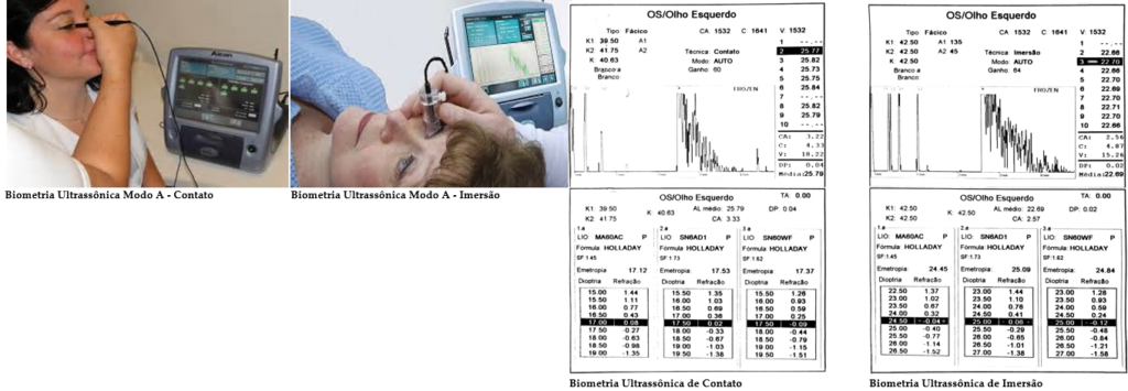 Imagem dos tipos de exames de biometria ultrassônica (imersão e contato) com o cálculo do grau da lente