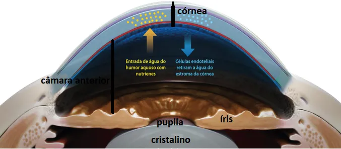 Imagem do olho mostrando a córnea (lente natural anterior do olho) e sua camada mais profunda (o endotélio e as células endoteliais que retiram água da córnea e permitem a sua transparência), a câmara anterior do olho, a íris e o cristalino