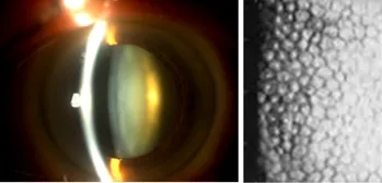 imagem mostrando a hora ideal de operar: catarata mole que não aperta a câmara anterior do olho e não causa muita morte das células do endotélio da córnea 