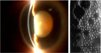 imagem mostra hora não muito boa de operar: catarata muito dura que aperta a câmara anterior do olho e causa muita morte das células do endotélio da córnea 