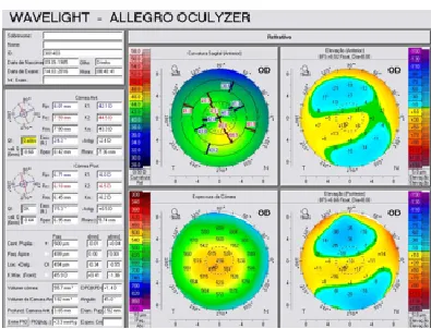 Exame de pentacam de córnea com ceratocone inicial: assimetria, curvatura alta, espessura corneana fina, e elevações anterior e posterior alteradas