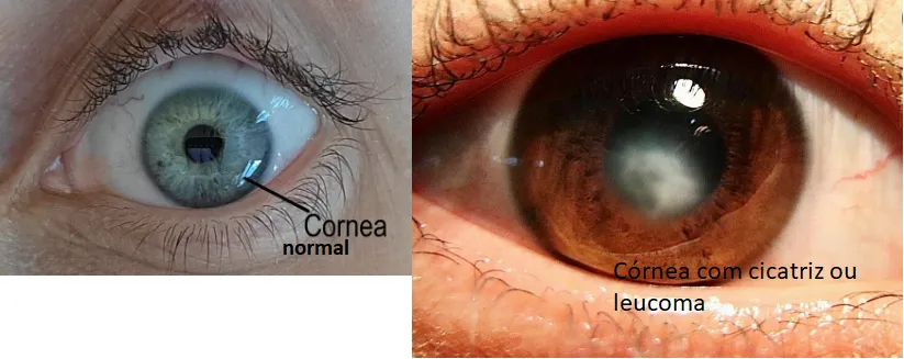 Imagem mostra córnea normal (transparente) e córnea com leucoma (cicatriz)