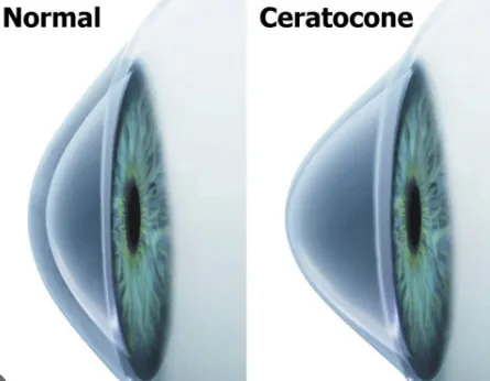 Imagem mostra córnea normal e córnea com ceratocone (fina e em formato de cone)