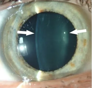 imagem de biomicroscopia à lâmpada de fenda  mostrando lente intraocular natural (cristalino) transparente