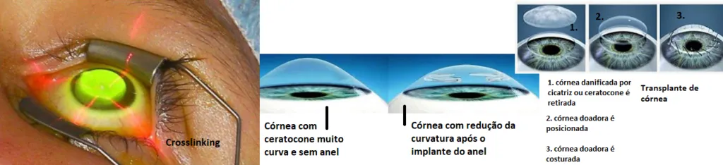 Imagem mostra os tratamentos cirúrgicos do ceratocone: crosslinking, anel corneano e transplante de córnea