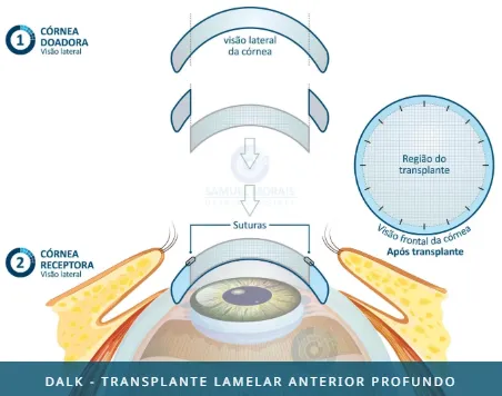 Imagem de DALK: espessura total da córnea doadora é suturada na córnea receptora onde restaram apenas as camadas mais profundas (Descemet e endotélio)