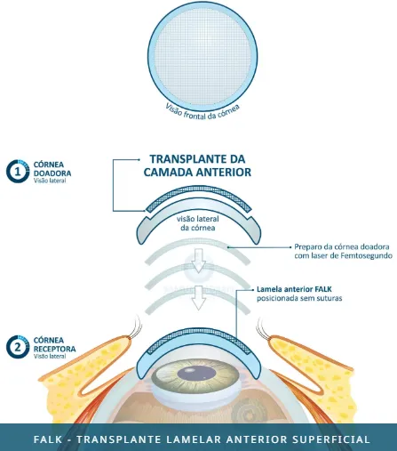 Imagem de Transplante Lamelar Anterior Profundo com uso de laser de Femtosegundo (FALK)