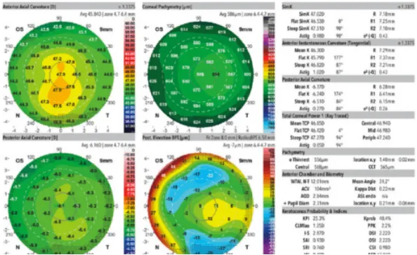 Exame Galilei mostrando ceratocone inicial: assimetria, curvatura alta, espessura corneana fina, e elevações anterior e posterior alteradas