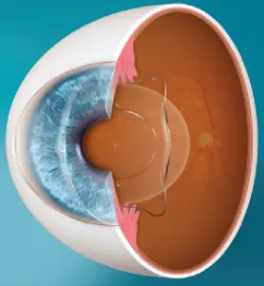 Imagem de lente intraocular de câmara posterior ICL: colocada entre a íris e o cristalino