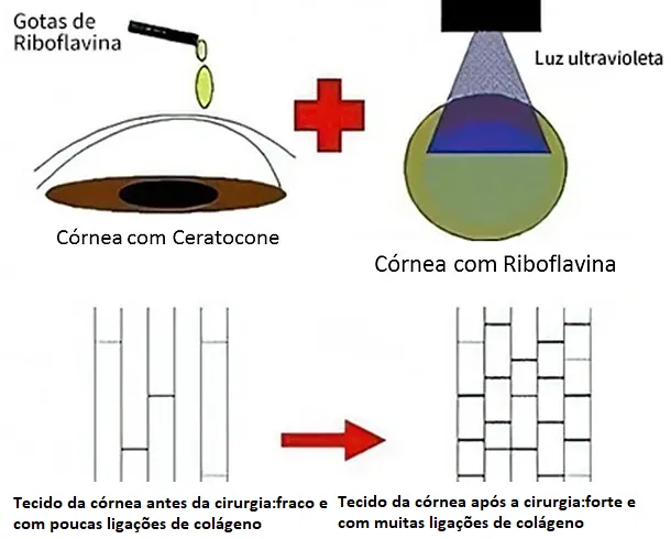 Ilustração mostrando a cirurgia de crosslinking (colírio de riboflavina e radiação ultravioleta) e o que ela faz no tecido corneano: fortalecimento através do aumento das ligações de colágeno para evitar a progressão