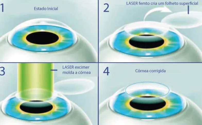 Imagem mostra a cirurgia de LASIK, onde é criado um retalho na córnea superficial pelo laser de fentosegundo, posteriormente o laser excimer retira o grau (molda a córnea) e o retalho é reposicionado