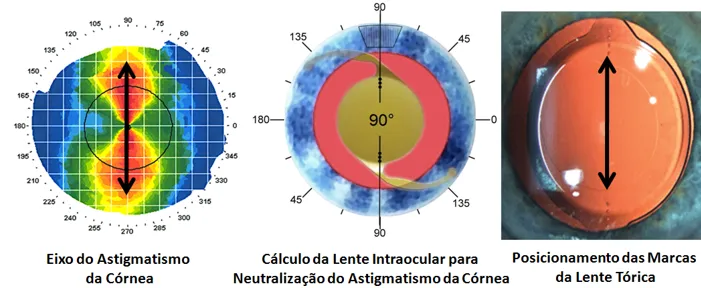 Imagem mostra o eixo do astigmatismo corneano, o resultado do cálculo da lente e a lente tórica devidamente implantada no olho