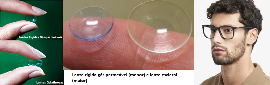 Lentes gelatinosas, rígidas e óculos no tratamento do ceratocone