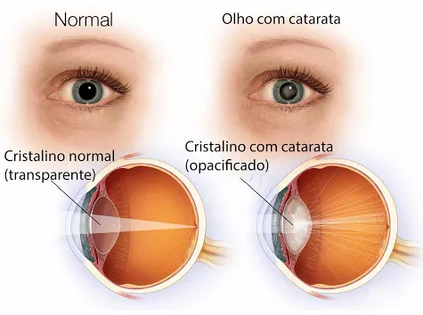 imagem mostra que cristalino transparente permite a entrada dos raios de luz e formação de imagem nítida na retina e cristalino com catarata dificulta a entrada dos raios de luz e gera imagem borrada