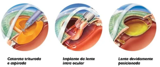 imagem mostrando os principais passos da cirurgia de catarata, da esquerda pra direita: laser triturando e aspirando a catarata; implante da lente intraocular e lente artificial devidamente  implantada dentro da cápsula do cristalino