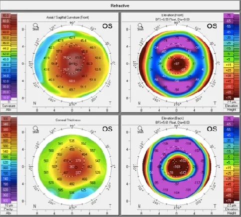 Exame de pentacam de córnea com ceratocone avançado: curvatura muito alta, espessura corneana muito fina, e elevações anterior e posterior muito alteradas