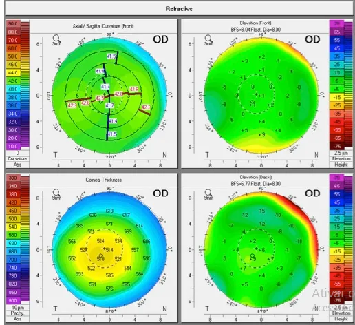 Exame de pentacam de córnea normal: ausência de assimetria, curvatura normal, espessura corneana e elevações anterior e posterior normais