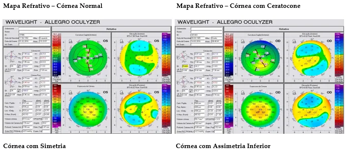 imagem de exame de tomografia de córnea pentacam