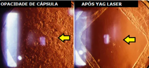 imagem mostra opacidade de cápsula posterior antes do yag laser e após o yag laser