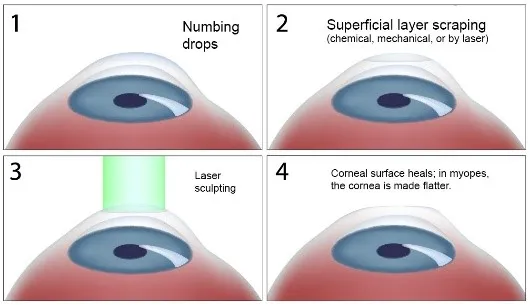 Imagem da cirurgia de PRK: o epitélio da córnea (camada superficial) é retirado e posteriormente é realizado o excimer laser (que remodela a córnea)