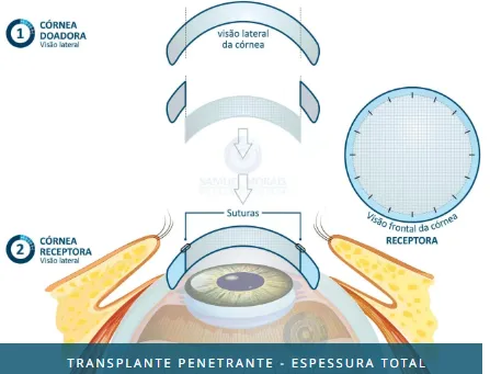 Imagem mostrando que no transplante penetrante é retirada a parte central da córnea doadora , em sua espessura total e costurada (suturada) na córnea receptora