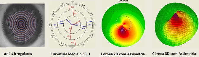 Imagem mostra exame de topografia de córnea com ceratocone avançado: curvatura alta e grande assimetria superior e inferior