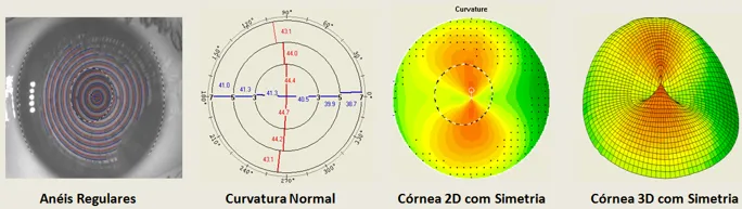 Imagem de exame de topografia de córnea normal: curvatura normal e simetria superior e inferior