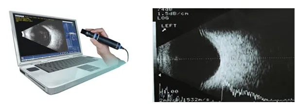 imagem do exame de ultrassonografia ocular para avaliar se a retina está colada