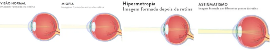 Imagem mostra a formação das imagens no olho normal (na retina), no olho míope (antes da retina), no olho hipermétrope (depois da retina) e no olho astigmata (em diferentes pontos da retina)