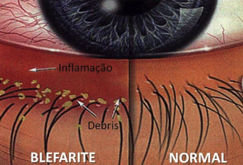 Imagem mostra à esquerda a blefarite: olho vermelho, pálpebra inflamada e com depósitos na base dos cílios