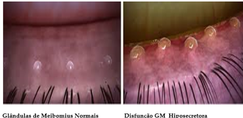 Imagem mostra a borda palpebral com glândulas de Meibomius (produtoras da gordura da lágrima) normais à esquerda e disfuncionais à direita