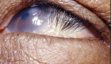 Imagem mostra triquíase (cílios entrando nos olhos) causa inflamação ocular crônica e consequentemente cicatrizes na córnea e baixa visão