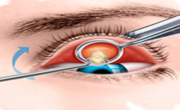 Cirurgia de calázio em fase crônica: drenagem da secreção, quando não houve regressão mesmo com tratamento clínico