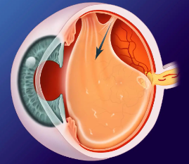 O descolamento do gel vítreo por algum fator (envelhecimento, cirurgia ocular, trauma) é a causa mais comum de moscas volantes