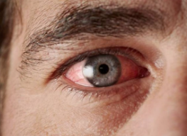 imagem mostra que se os tremores de pálpebra persistirem por mais de uma semana ou os olhos estejam vermelhos, com secreção ou ardendo, não hesite em se consultar