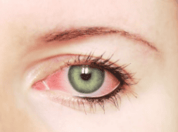 A maquiagem e a saúde ocular: atenção aos sinais e sintomas de alergia: vermelhidão ocular, coceira, queimação, descamação de pele