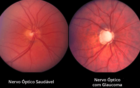 Glaucoma avançado: visão embaçada
